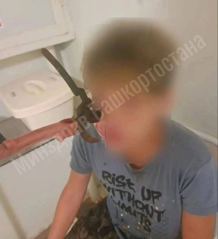 Секатор, вонзившийся в лицо подростка, извлечен хирургами